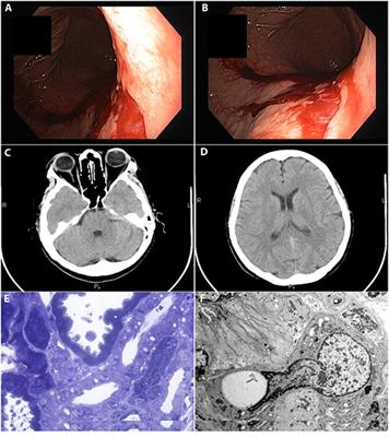 Case Report: Hyponatremia Secondary to Desmopressin Administration Prior to Percutaneous Kidney Biopsy: A Case-Based Review